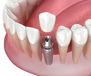 Illustration of single dental implant