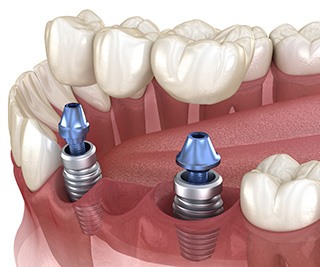 Illustration of implant bridge