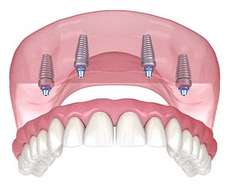 Illustration of an implant denture