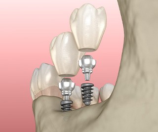 Illustration of mini dental implants