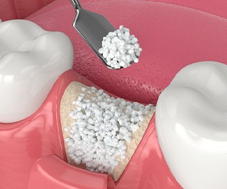 Illustration of bone graft