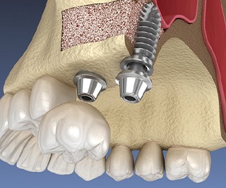 Digital illustration of a sinus lift