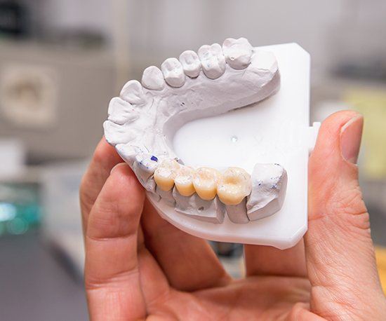 Model smile with fixed bridge restoration