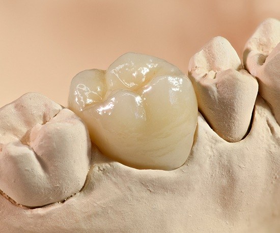 Model smile with dental crown restoration