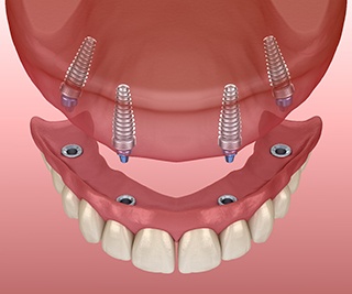 Denture patient in Murphy eating