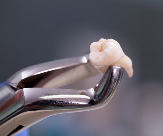 Metal clasp holding extracted tooth