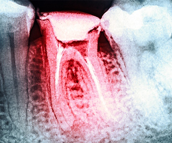 X-ray of root canal treated tooth