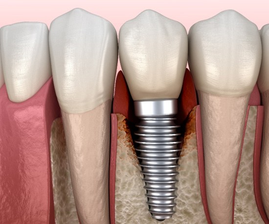 Illustration of bone loss around a failed dental implant in Murphy, TX