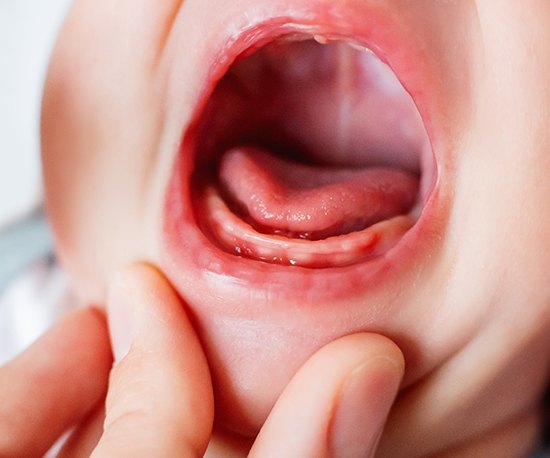 older child with a tongue tie (for the Why Is It Important to Treat section)