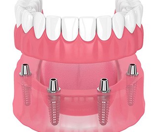 illustration of implant dentures for cost of dentures in Murphy