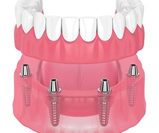 illustration of implant dentures for cost of dentures in Murphy