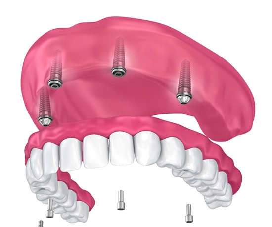 implant denture being placed on the upper arch