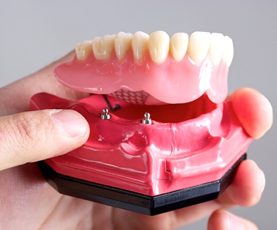 person holding a model of an implant denture in their hand