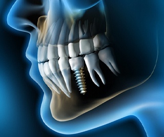 X-ray of a person with a single dental implant