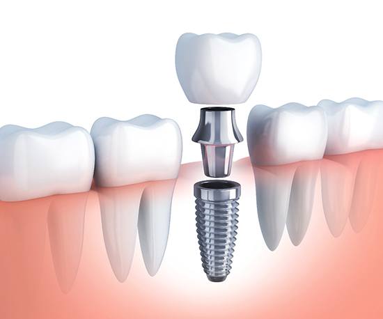 dental implant replacing a missing lower tooth