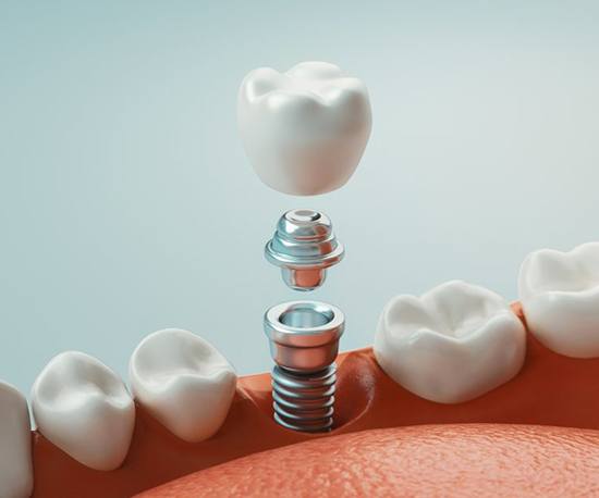 dental implant replacing a missing lower tooth 