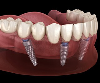 implant denture on the lower arch 