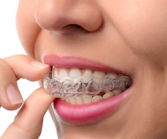 person inserting clear aligner