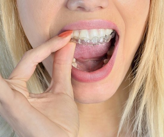 woman taking out Invisalign in Murphy aligner