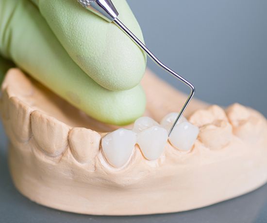 Model smile with fixed bridge restoration