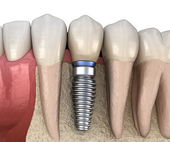 Animation of implant supported dental crown