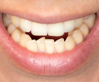 Closeup of crooked teeth in Murphy before braces