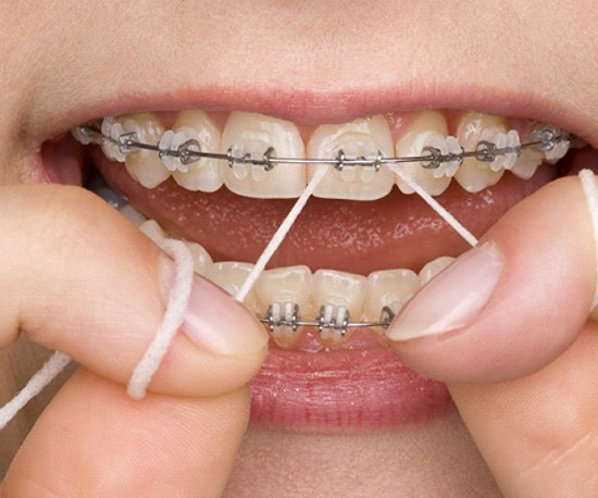 Closeup of patient flossing with braces in Murphy