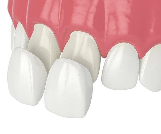 Digital image of porcelain veneers being placed over the top two teeth