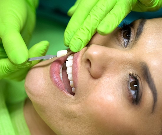 A woman having a porcelain veneer placed over a tooth located on the top row of teeth