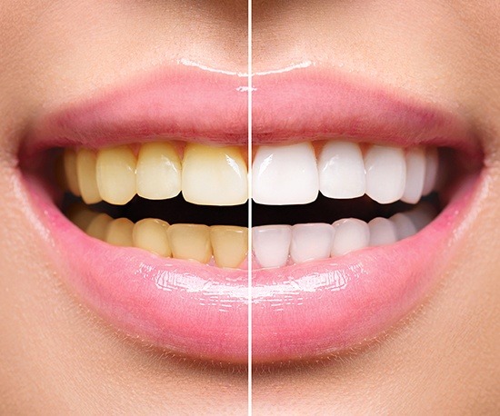 Closeup of smile before and after teeth whitening