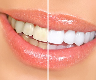 Smile with sparkly gloss halved to show before/after teeth whitening