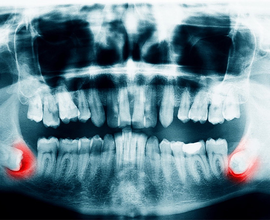 X-ray of wisdom teeth in Murphy 