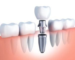 diagram of dental implant in Murphy