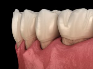 Illustration of gum recession that may be treatable with ozone therapy