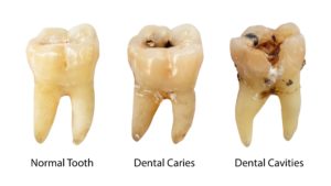 Different stages of tooth decay