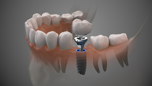 3D render of a dental implant