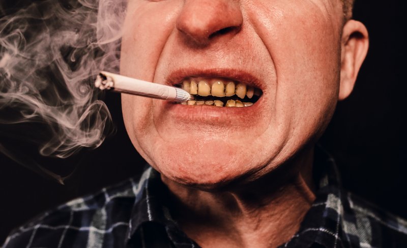 Smoking is a terrible habit for dental implants